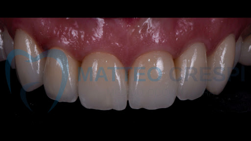 Studio Dentistico Faccette Dentali
